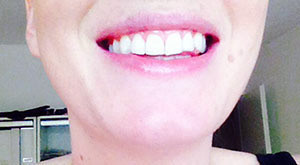 Smiletastic Schiene Bleaching passt perfekt